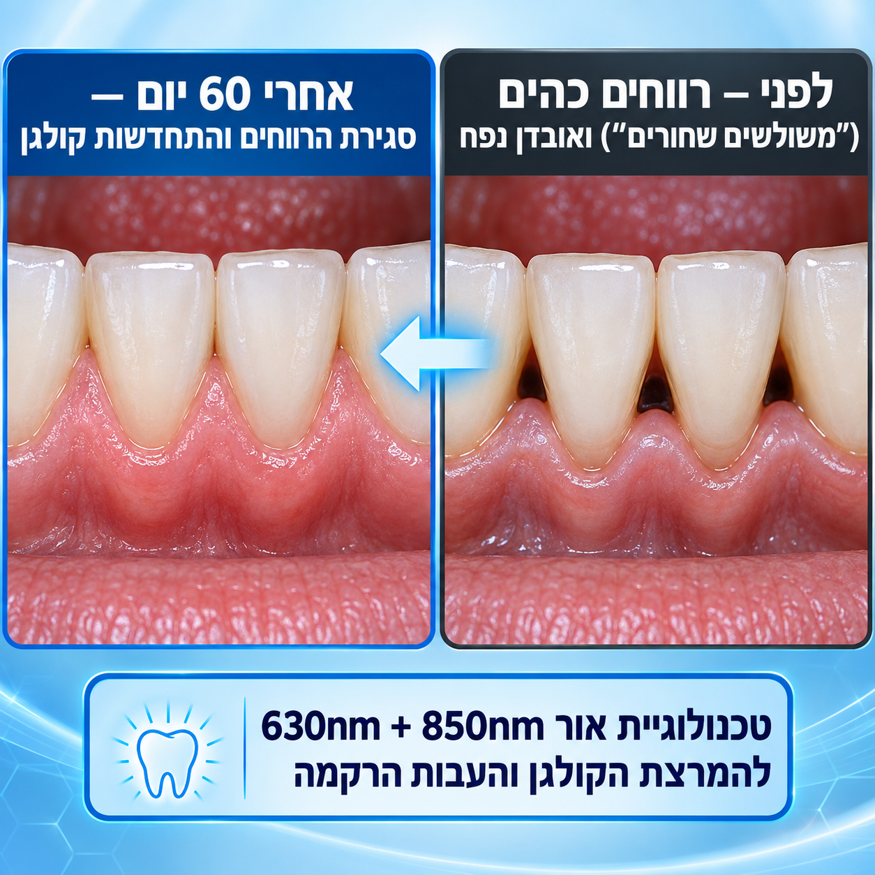 GumRenew Pro - טיפול אור אקטיבי בחניכיים ב-12 דקות ביום