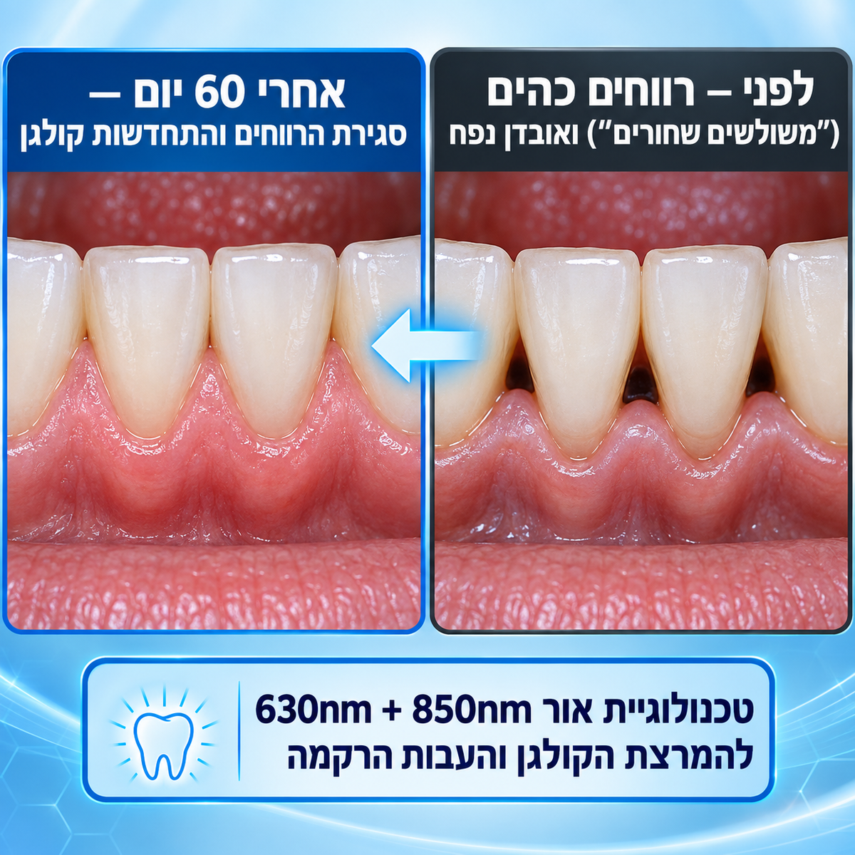 GumRenew Pro - טיפול אור אקטיבי בחניכיים ב-12 דקות ביום