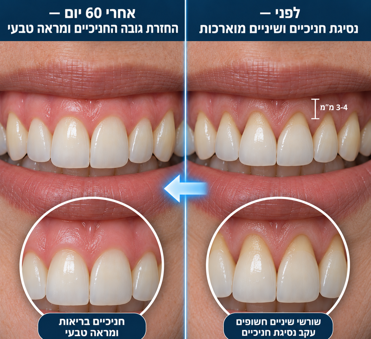 GumRenew Pro - טיפול אור אקטיבי בחניכיים ב-12 דקות ביום